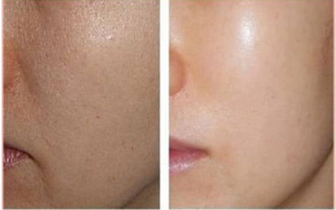 Before After of Skin Booster