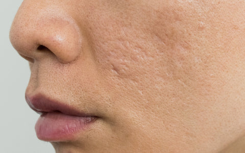 Potential Side Effects of Microneedling
