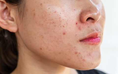 Redness And Swelling after microneedling