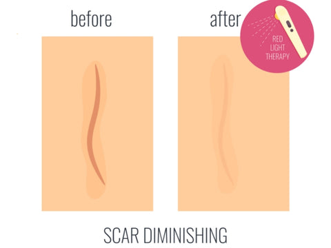 Scar Reduction and Removal with Microneedling