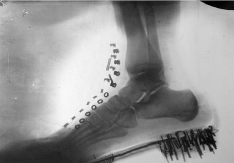 tesla x ray rendgenski snimak stopala