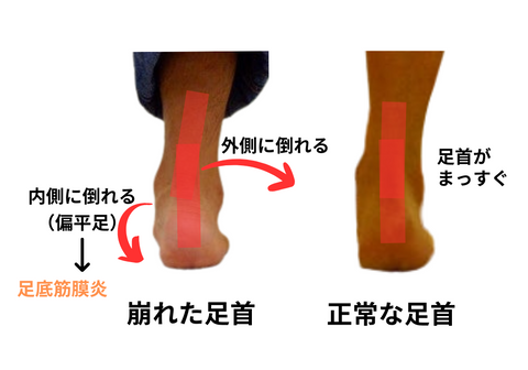 偏平足　足底筋膜炎　治し方