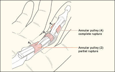 Annular Pulley Injuries