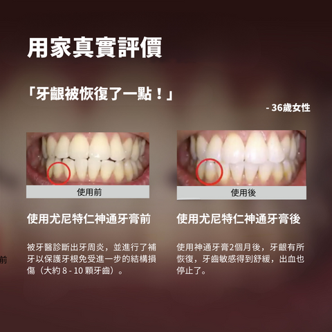 用家真實評價  「牙齦恢復了一點！」 前 使用 Unitein 口香糖牙 膏之前  被牙醫診斷出牙周炎，並進行了補牙以保護牙根免受進一步的結構損 傷（大約 8 - 10 顆牙齒）。  - 36歲女性 後 使用Unitein口香糖 牙膏後  使用神通牙膏2個月後，牙齦有所恢復，牙齒敏感得到抵抗，出血也停止 了。