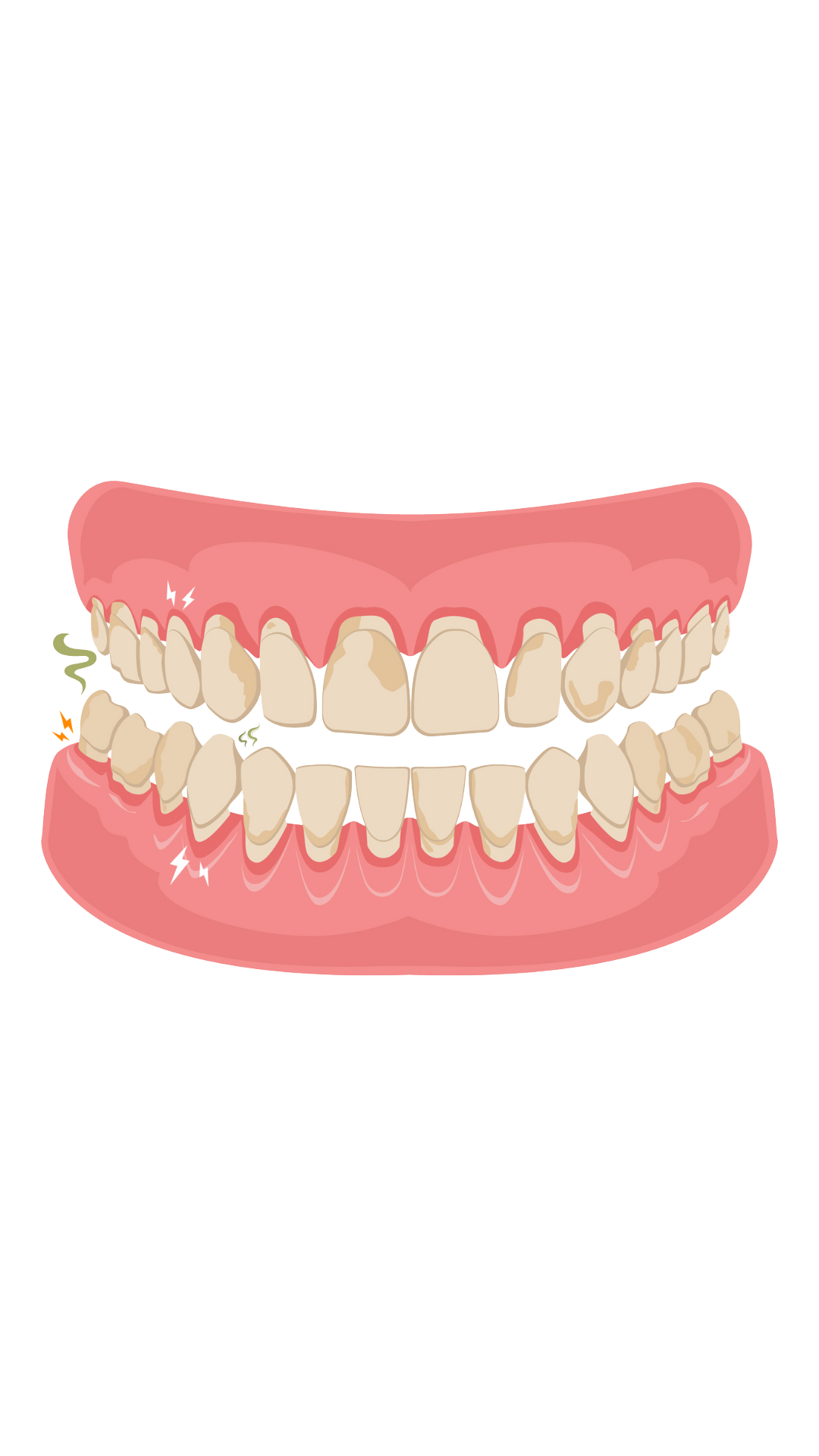 Gums with recession, inflammation, bleeding, and sensitivity