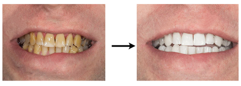 Angelsmile™ High-Energy Visible (HEV) Zahnpflegeinstrument