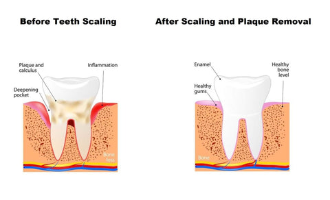 Angelsmile™ High-Energy Visible (HEV) Tooth Therapy Instrument