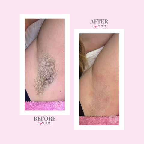 Underarm Before and After by Dr Wax