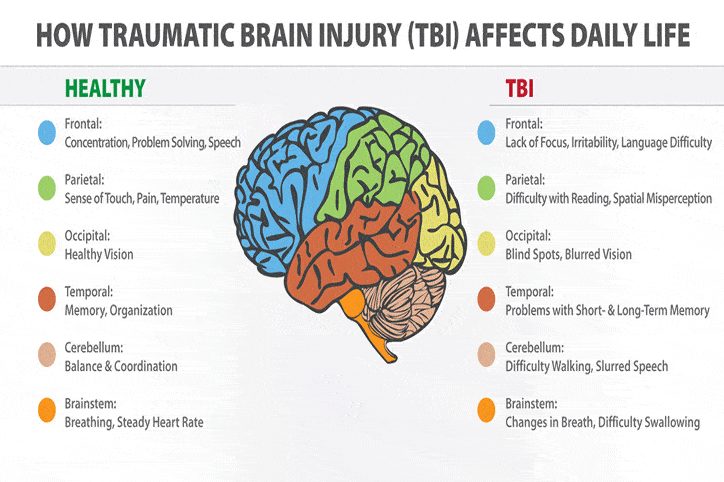 Traumatic brain. TBI. Concussion Ram Palanite.