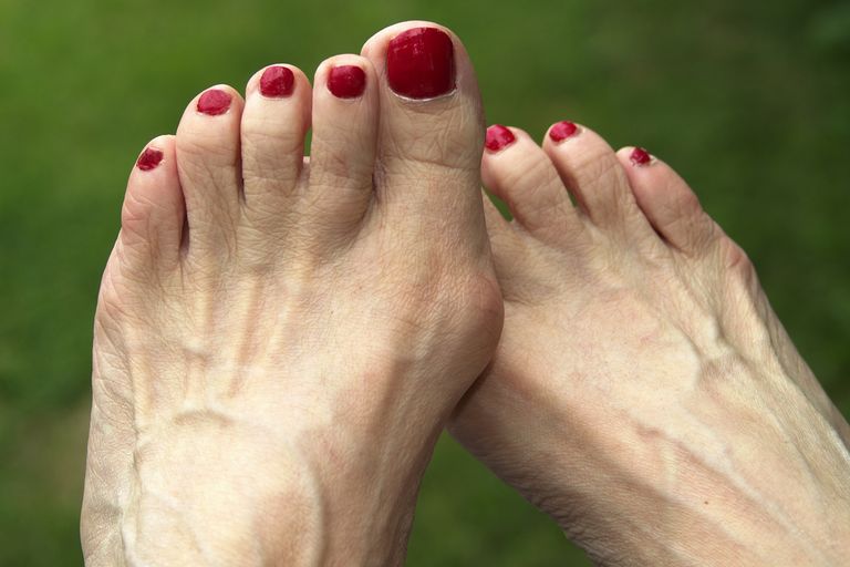 elderly woman's foot bunion and hammer toes foot ailment red toenails