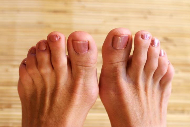 hammer-toes-foot-ailment-womans-feet