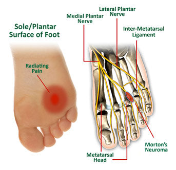 graph chart labels foot nerve metatarsal ligament plantar morton's neuroma radiating pain