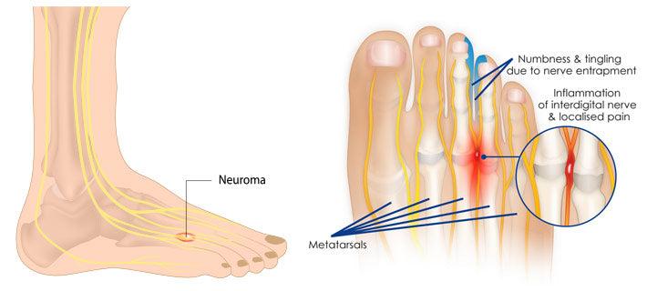 foot diagram neuroma metatarsals nerve pinch and damage foot pain
