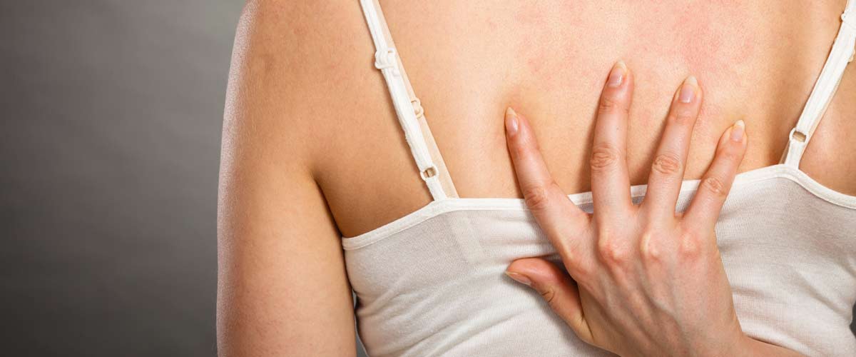 Eine Frau hat einen schmerzenden Hautausschlag am Rücken, was als Gürtelrose bezeichnet wird.
