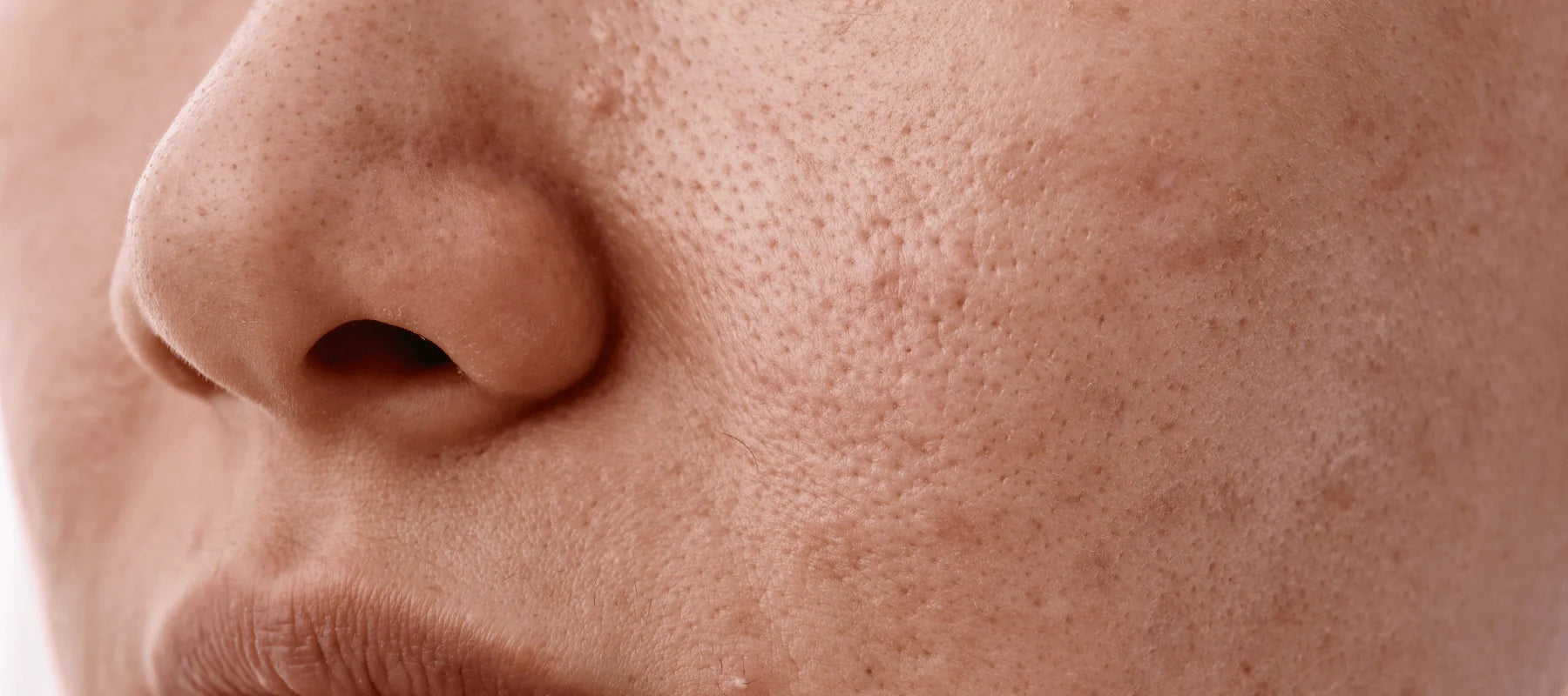 Depicting_different_types_of_pitted_scars_on_the_skin_s_surface-min.webp__PID:85d81921-59ba-4dac-b6a5-8cbbe04225c3
