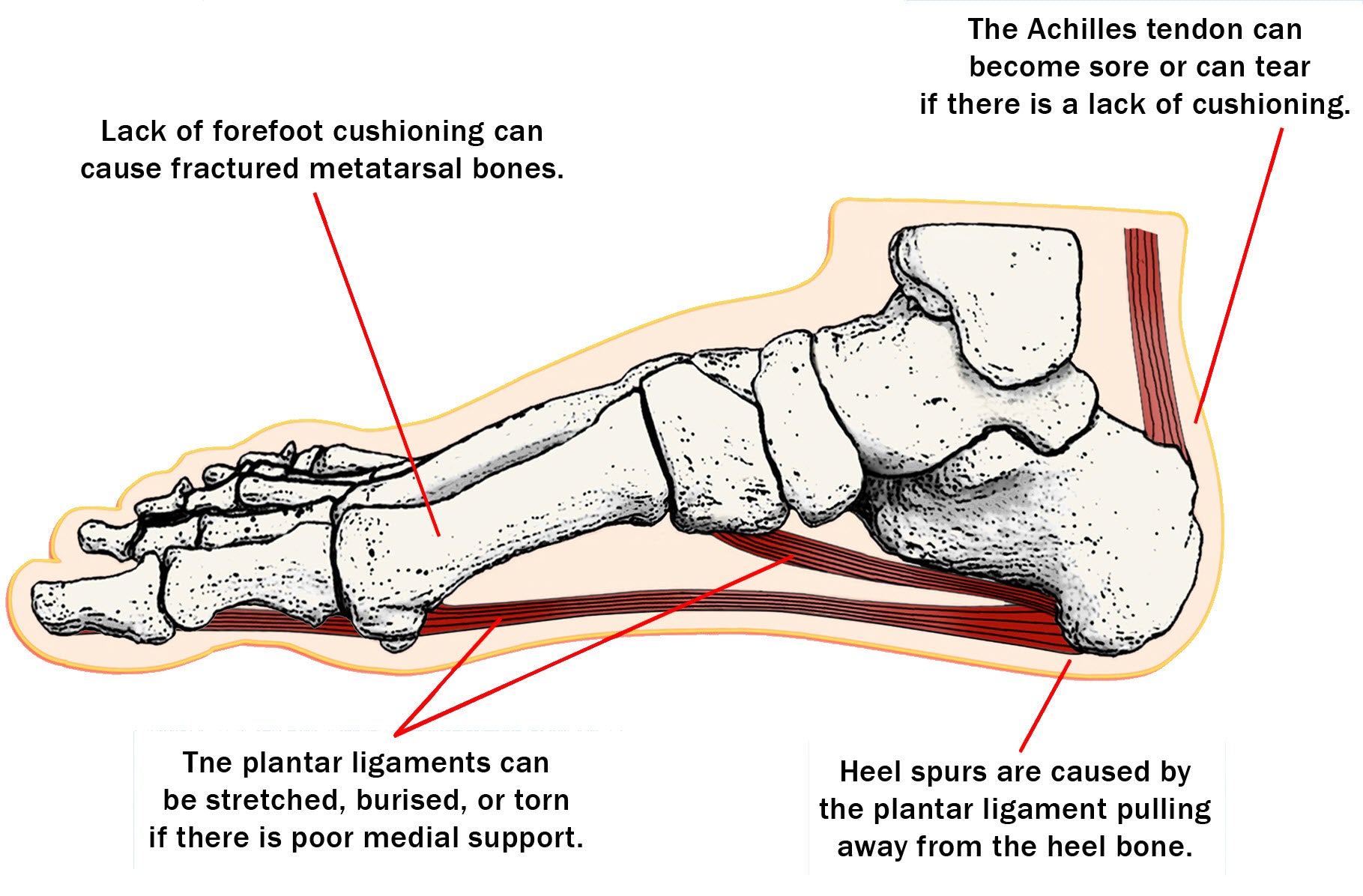 PDF) Double heel or calcaneal spur A rare entity.