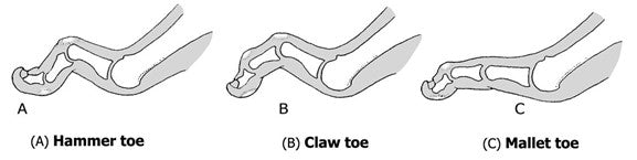 hammer-claw-mallet-toe.jpg