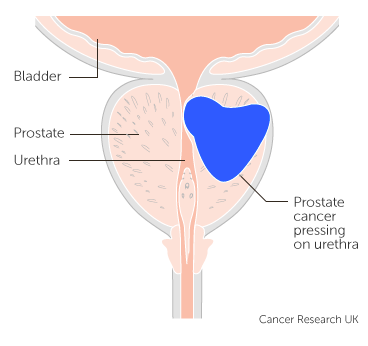 Prostate Cancer pressing on urethra