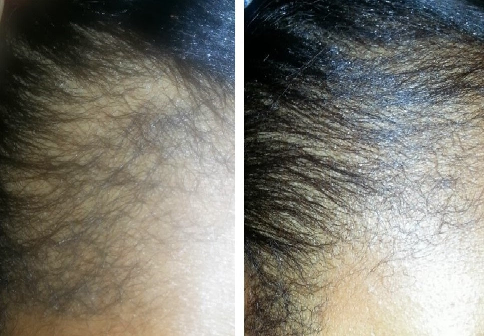 Hair Loss & Thinning