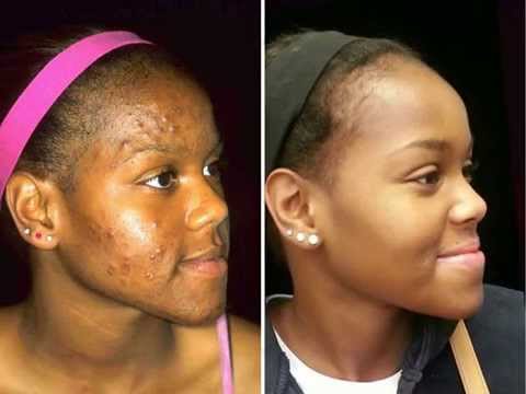 Cystic-Acne-Remedy-Kenya