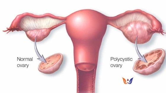 Fertility Supplements for Women With PCOS [Available in Kenya]