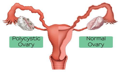 Polycystic Ovary & Estrogen Dominance