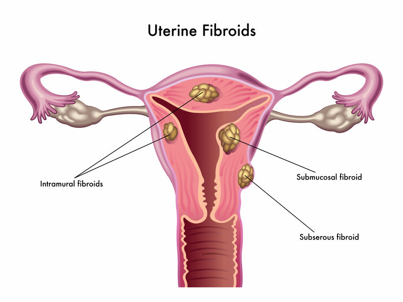 Uterus Fibroids & Estrogen Dominance