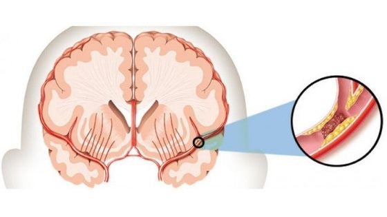 Vitamin-D Deficiency & Ischemic Stroke