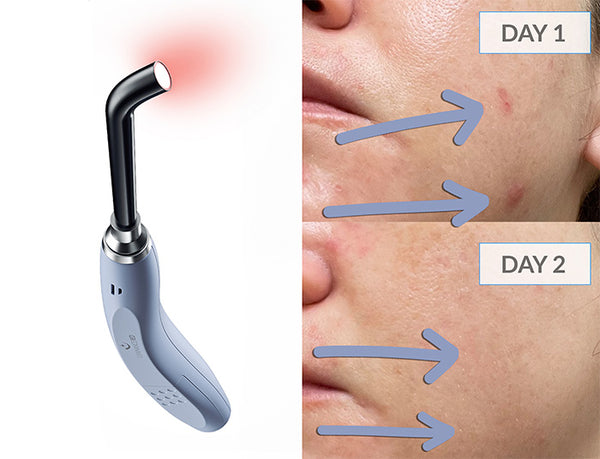 clearbeam acne device before and after red light blue
