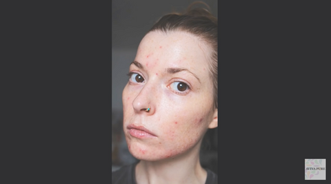 jojoba oil acne treatmend - skin before