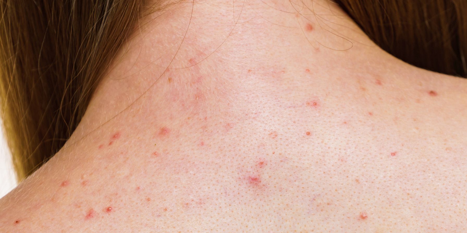 trattamento acne e brufoli per il corpo - la lumaca bianca