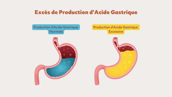 excès de production d'acide gastrique