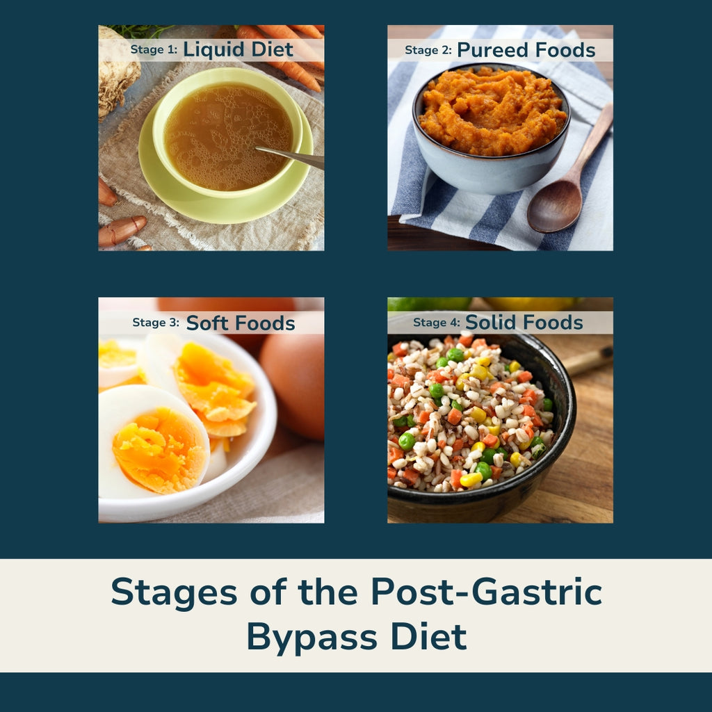 Stages of the Post-Gastric Bypass Diet