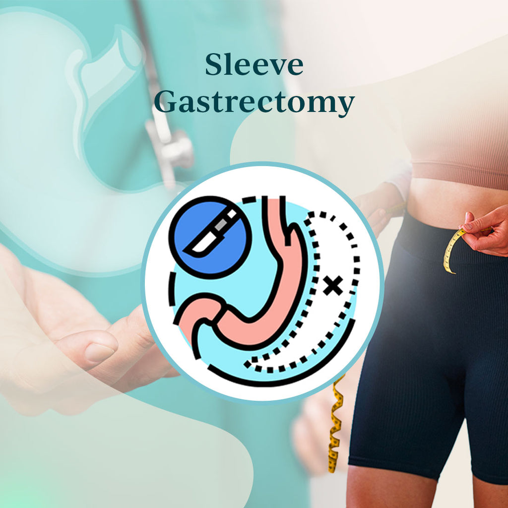 Sleeve Gastrectomy