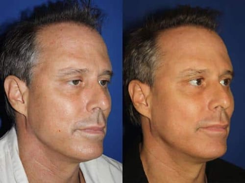 Side-by-side before and after photos of a man's profile, likely demonstrating cosmetic surgery results.