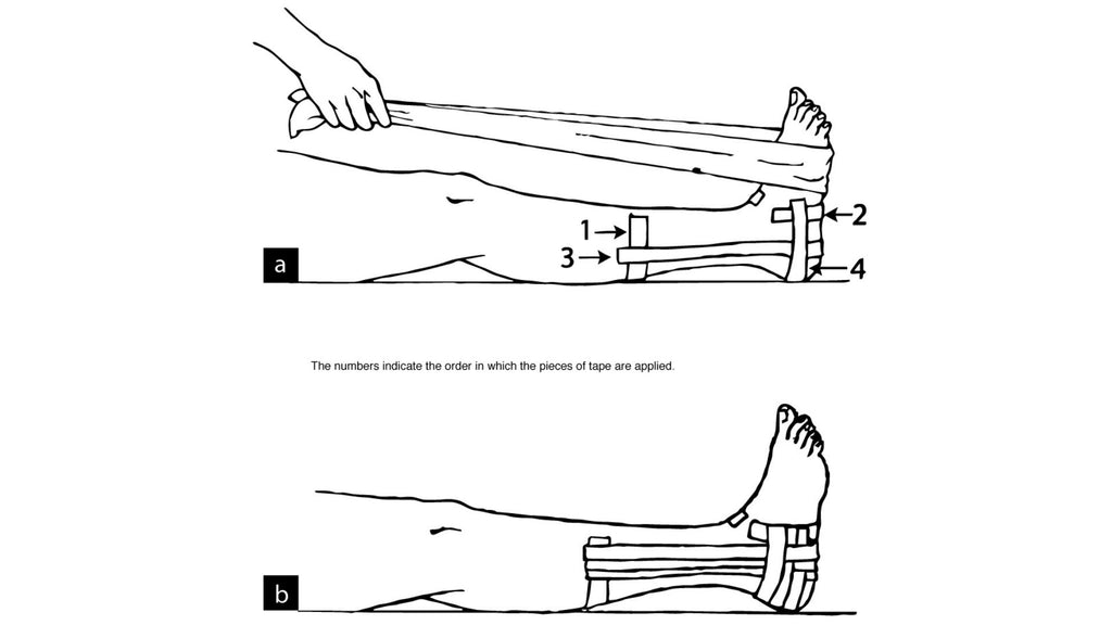 Sprained ankle taping using a cross-weave stirrup pattern