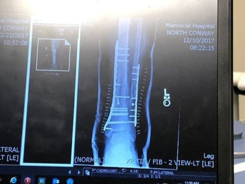 Shattered leg X-ray