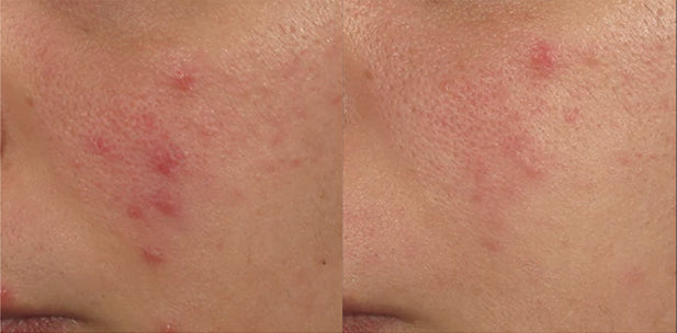 CLEAR CELL acne spot treatment