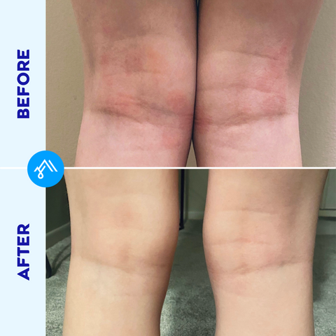 ARCTIVA Eczema Cream child Addison before and after photo