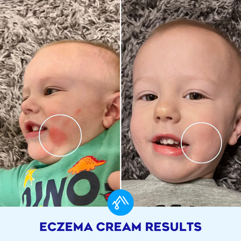 ARCTIVA Eczema Cream child Maverick before and after photo