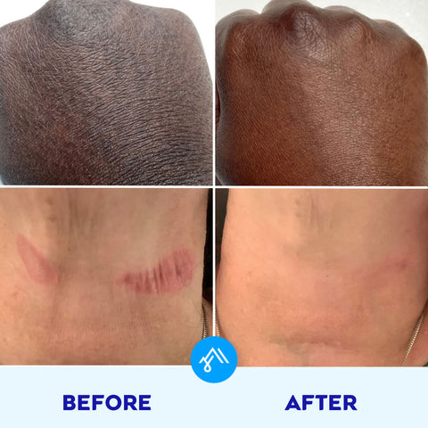 ARCTIVA Eczema Cream Consumer Panel Before & After Results