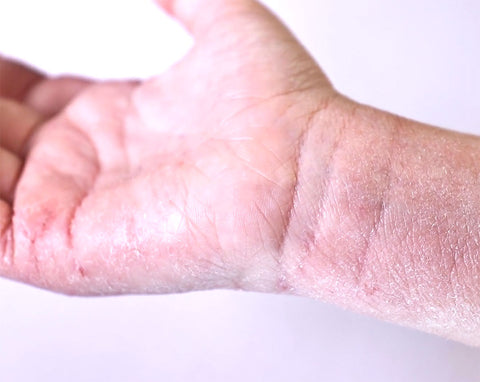 Hand with eczema on wrist