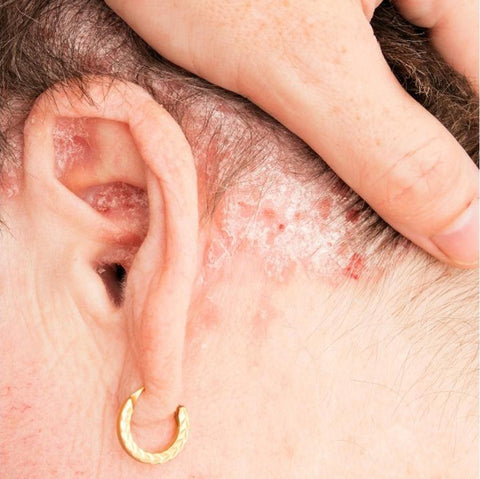 photo of psoriasis on ear