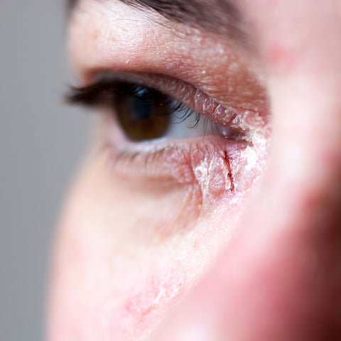 man with psoriasis around his eye