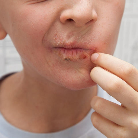 photo of psoriasis on lips