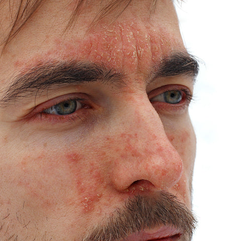 man with psoriasis on face