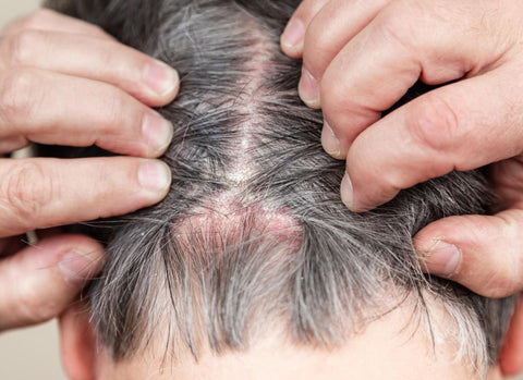 photo of scalp psoriasis is very common