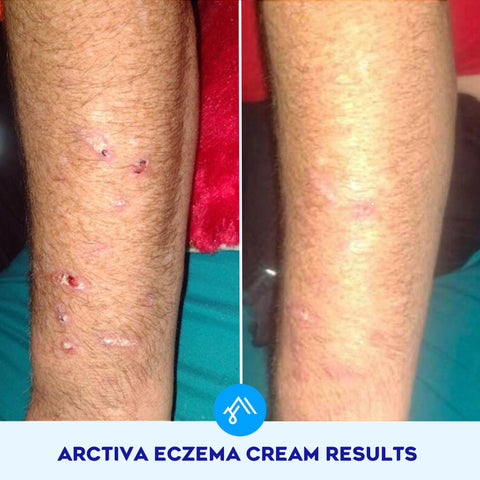 Before and after photos of non steroid eczema cream