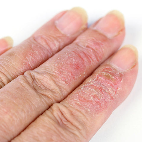 aging and eczema on older person's fingers