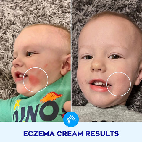Best eczema cream for kids